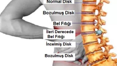 Bel Fıtığı Dengeleri